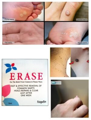 Rayuon Skincare Erase (15ml) For Removal of Common Warts, Heals Repairs & Clear